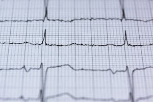 Zbliżenie na odprowadzenia monitora EKG na wydrukowanym kardiogramie, prezentujące diagnostykę zdrowia serca.