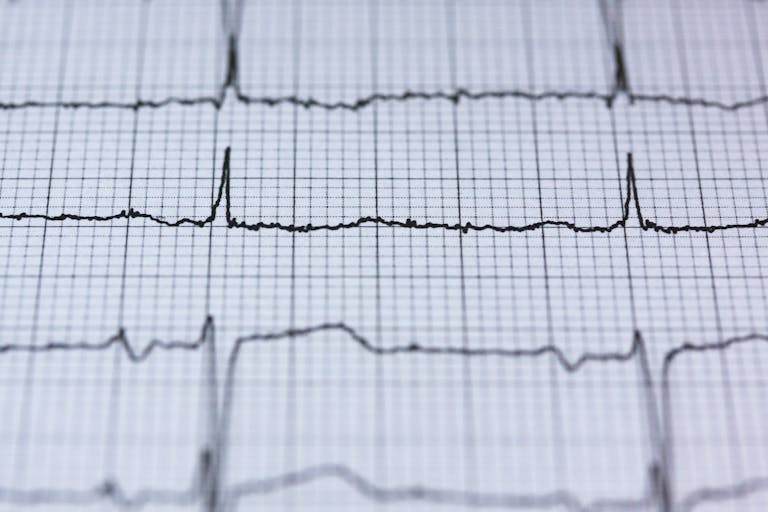 Zbliżenie na odprowadzenia monitora EKG na wydrukowanym kardiogramie, prezentujące diagnostykę zdrowia serca.