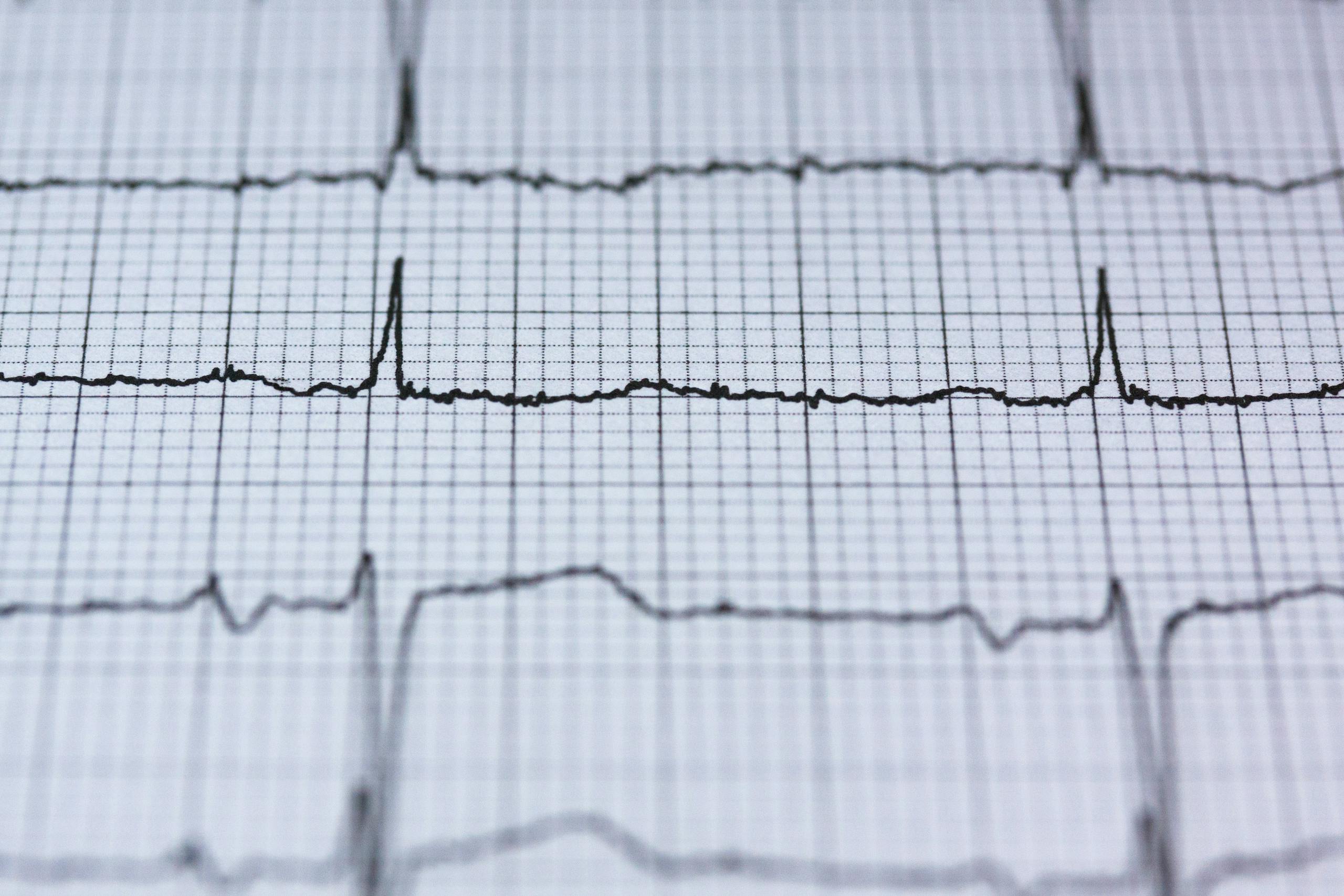 Zbliżenie na odprowadzenia monitora EKG na wydrukowanym kardiogramie, prezentujące diagnostykę zdrowia serca.